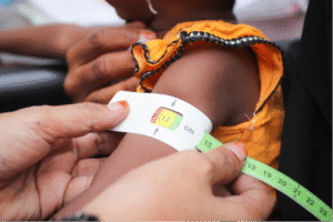 Malnutrition crisis: Securing the health and development of children under five